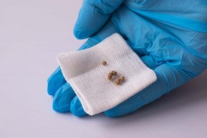 Klein aber schmerzhaft und lästig. Gallensteine können Schmerzen im Oberbauch und im Bereich der Bauchspeicheldrüse verursachen. Foto: Freepik/bycirinka