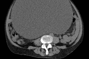 CT-Bild des Tumors