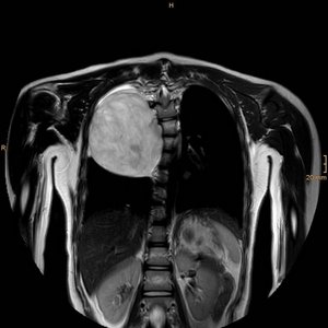 Der Tumor an der Wirbelsäule verdrängte bereits die Lunge